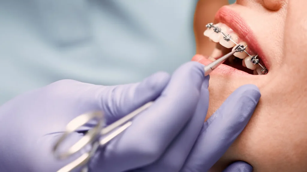 material de ortodoncia profesional, productos de ortodoncia, suministro dental especializado, distribuidor de ortodoncia, material dental para clínicas