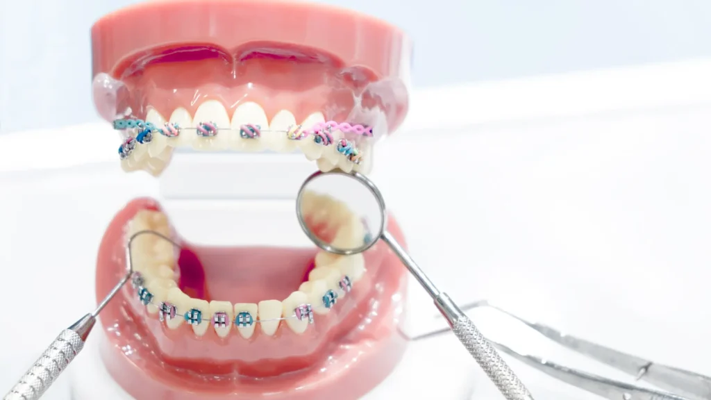 comparación de materiales de ortodoncia para clínicas dentales